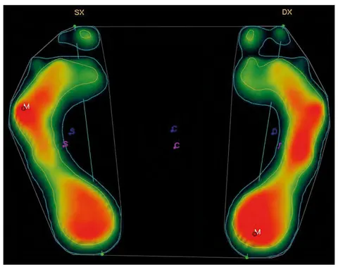 Schermata software: mappa pressoria plantare 3D dei piedi sinistro e destro con punti di massima pressione